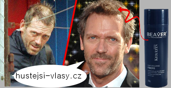 Vadí vám vypadávání vlasů? Existuje řešení